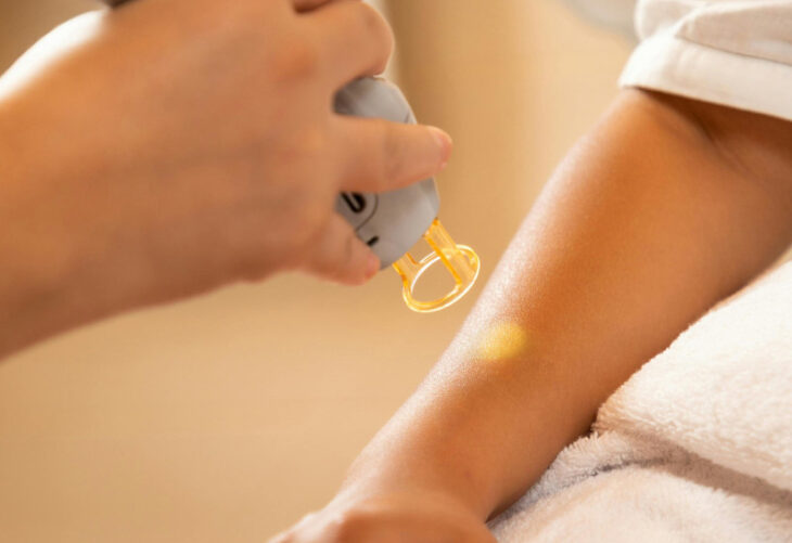 ¿Qué tipo de depilación le conviene a tu piel?